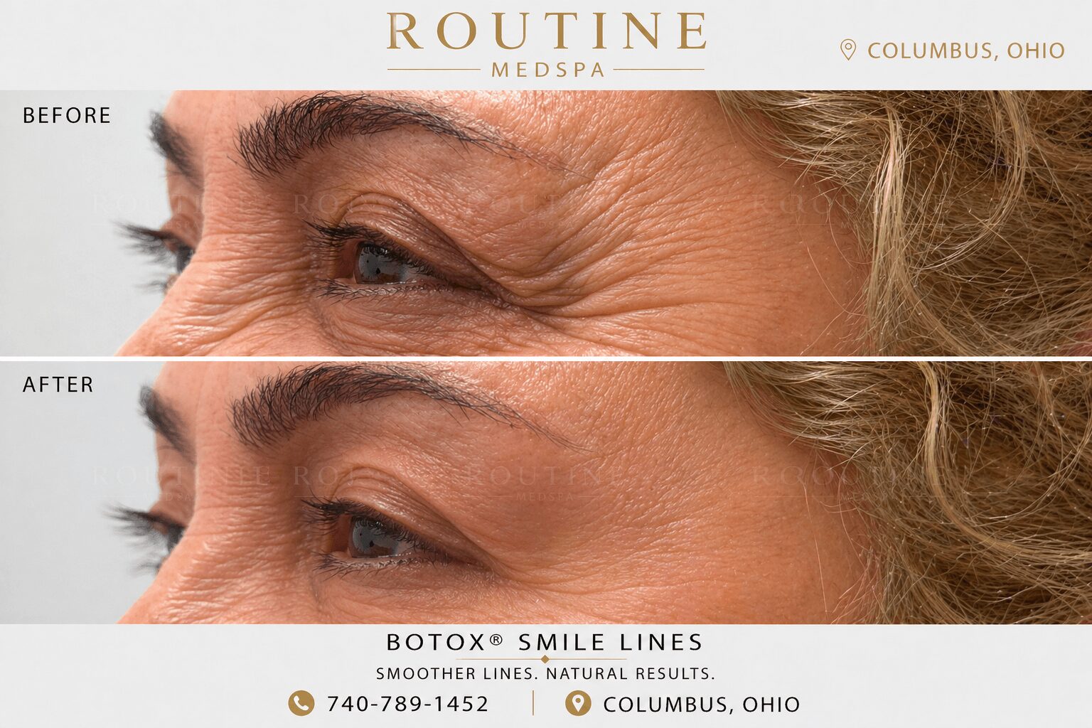 Close-up of a person's eye area showing before and after treatment for wrinkles and smile lines.