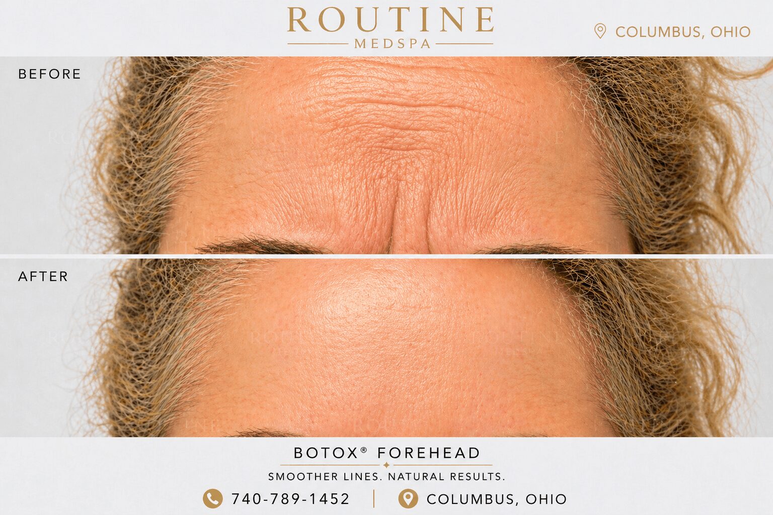 Comparison of forehead before and after treatment showing reduced wrinkles and smoother skin.