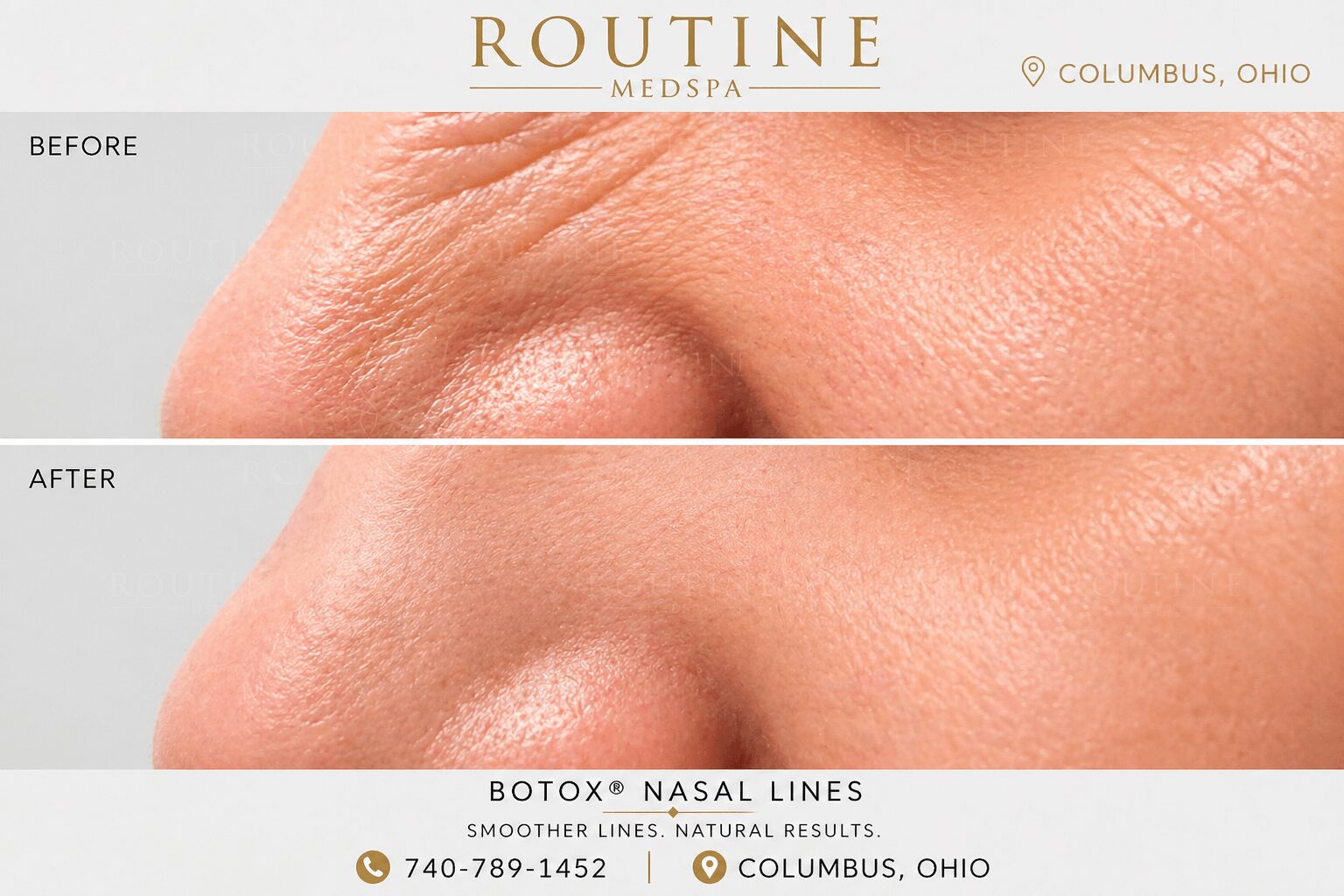 Close-up of forehead showing before and after skin treatment results, smooth skin, minimal lines, and even texture.