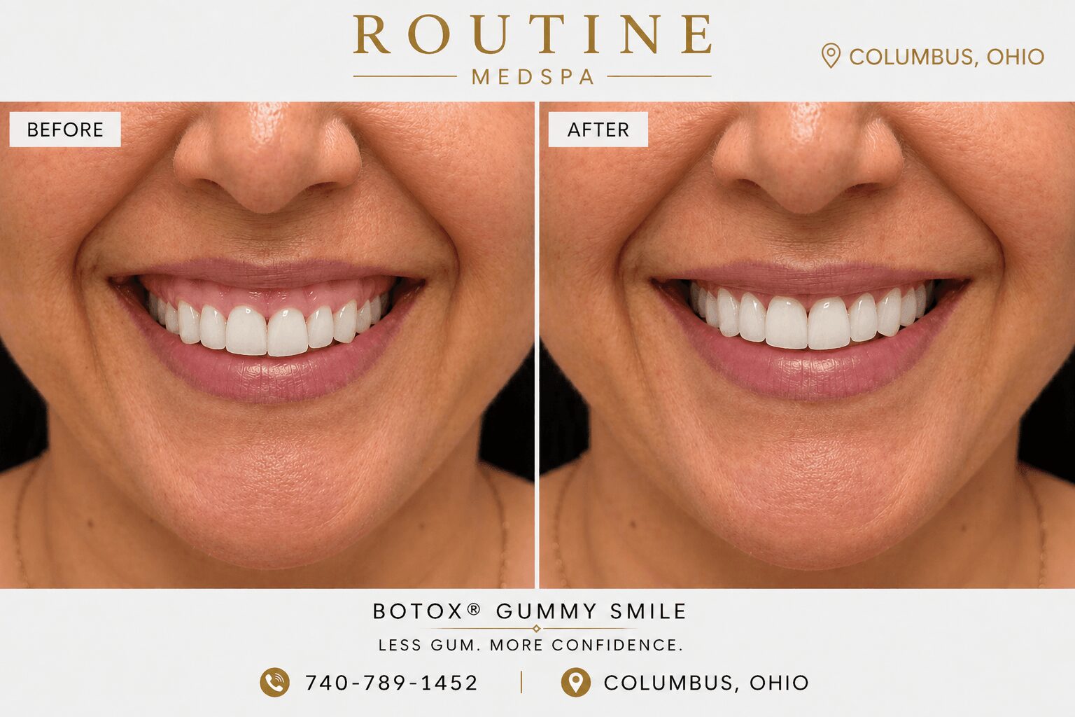 Side-by-side comparison of a person's smile before and after Botox and gummy smile treatment, showing improved confidence.